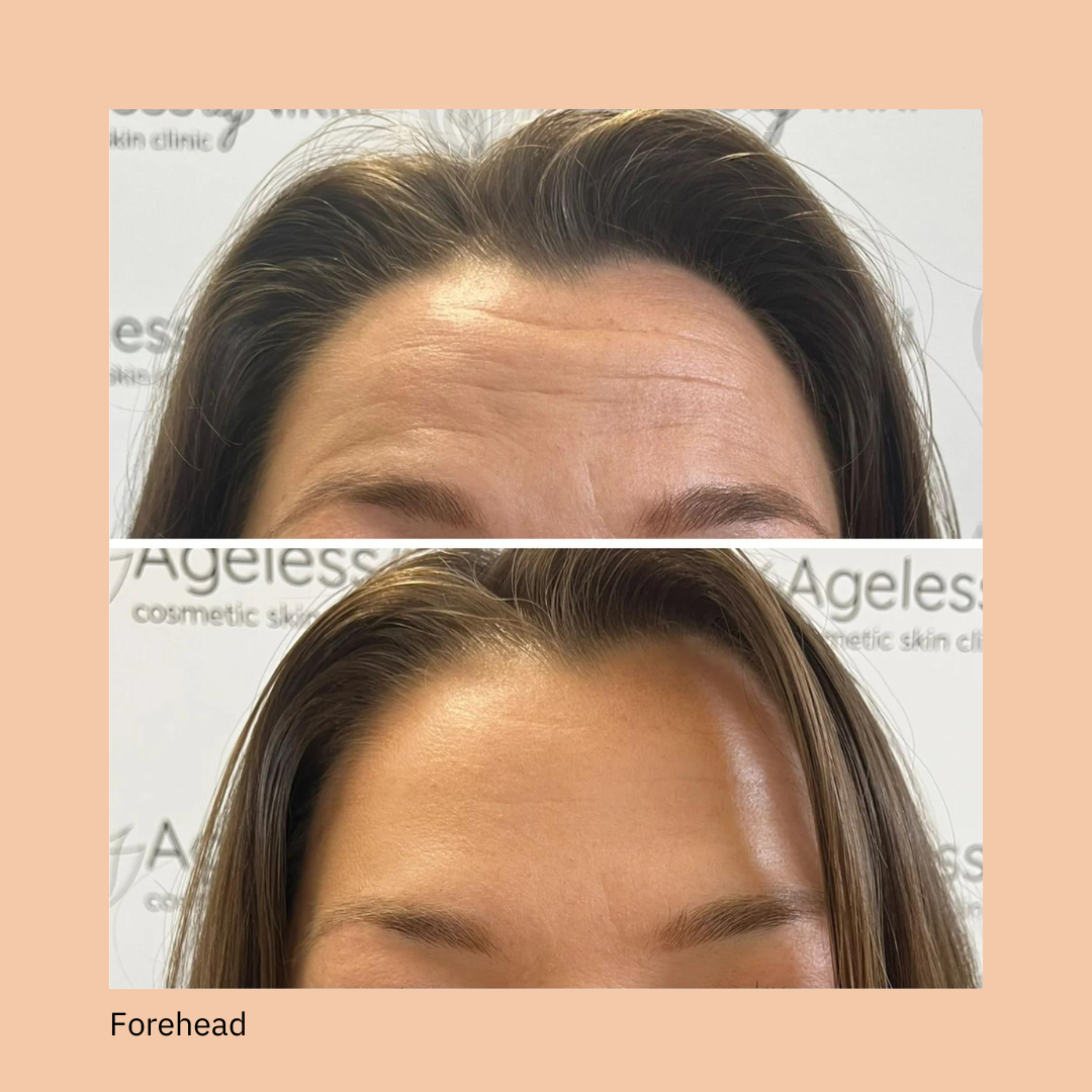 Anti-wrinkle treatment  - one area