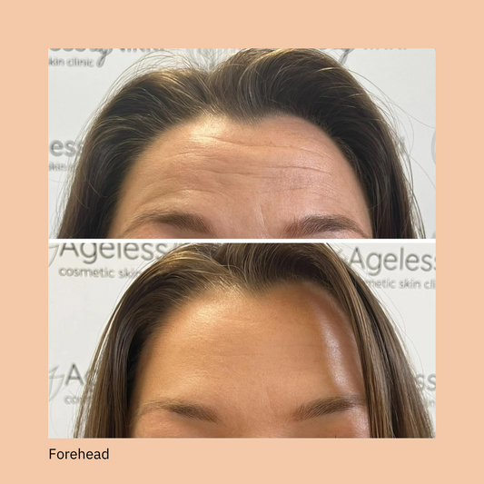 Anti-wrinkle treatment  - two areas