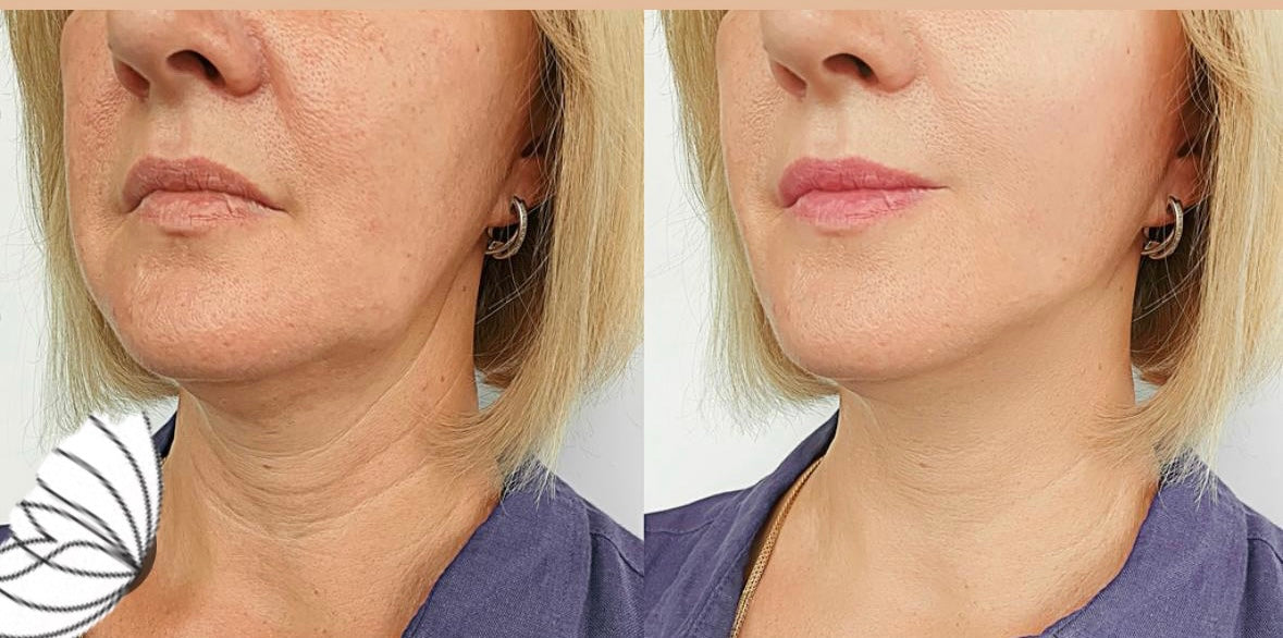 Full Face COG Thread Lift