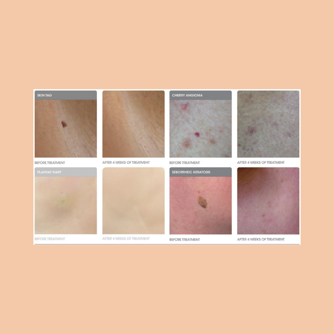 Cryopen Treatment - skin tag, mole, wart removal or Milia manual removal