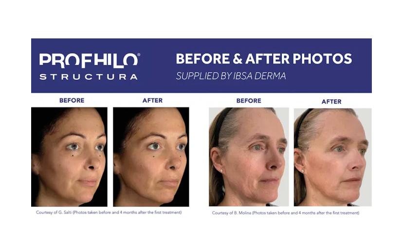 Profhilo® Structura (NEW PRODUCT)