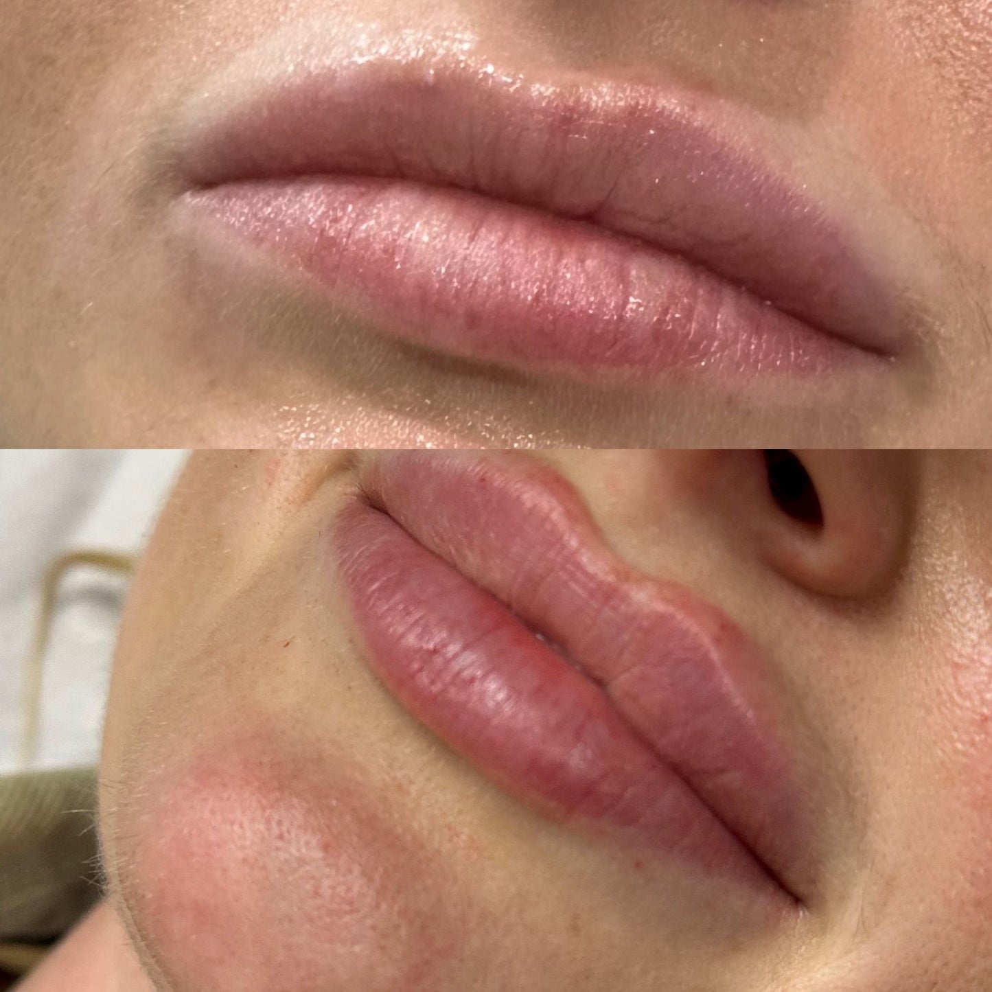 Dermal Fillers - Lips and fine lines 1ml