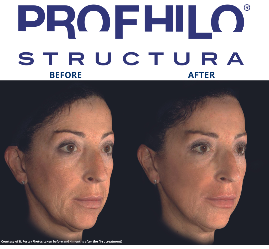 Profhilo® Structura (NEW PRODUCT)