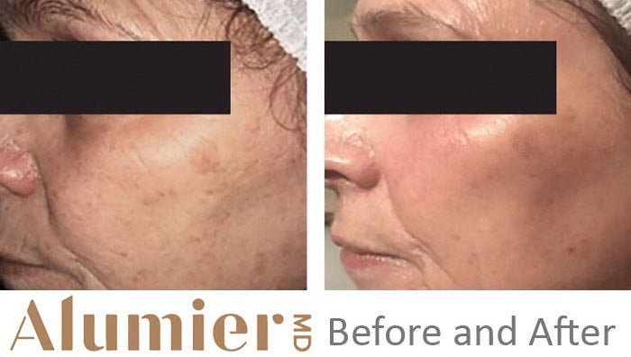 Alumier MD Peels