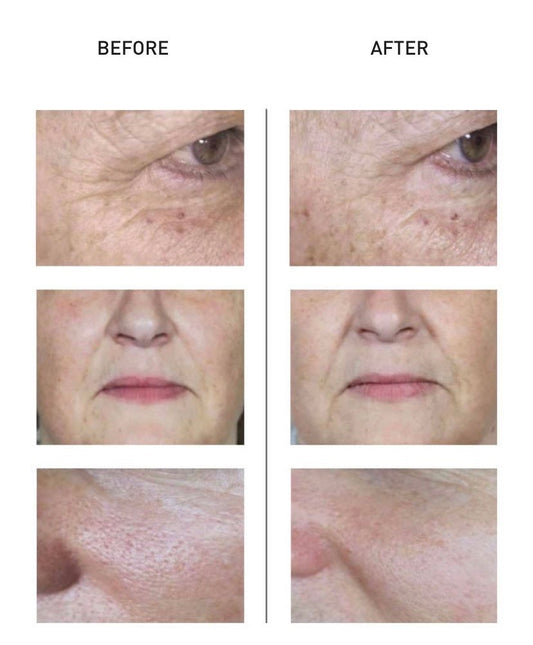 Revitalise Skin Quality with NCTF Skin booster