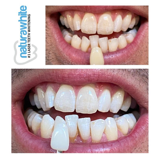 Teeth Whitening - 2 Sessions