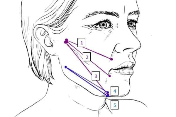 Full Face COG Thread Lift