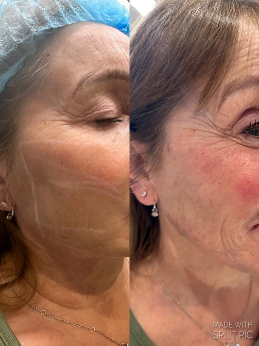 Full Face COG Thread Lift