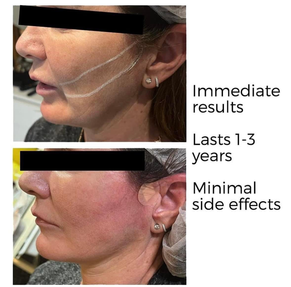 Full face and Neck PDO Thread Lift