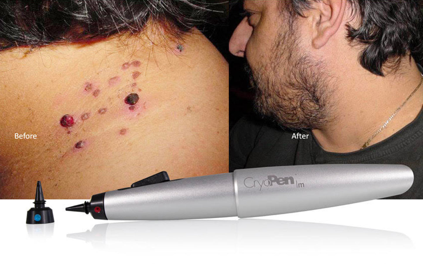 Before and after comparison of a skin treatment device on a person's skin.