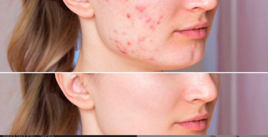 Understanding the Causes of Acne and Comprehensive Treatment Approaches at Ageless Skin Clinic