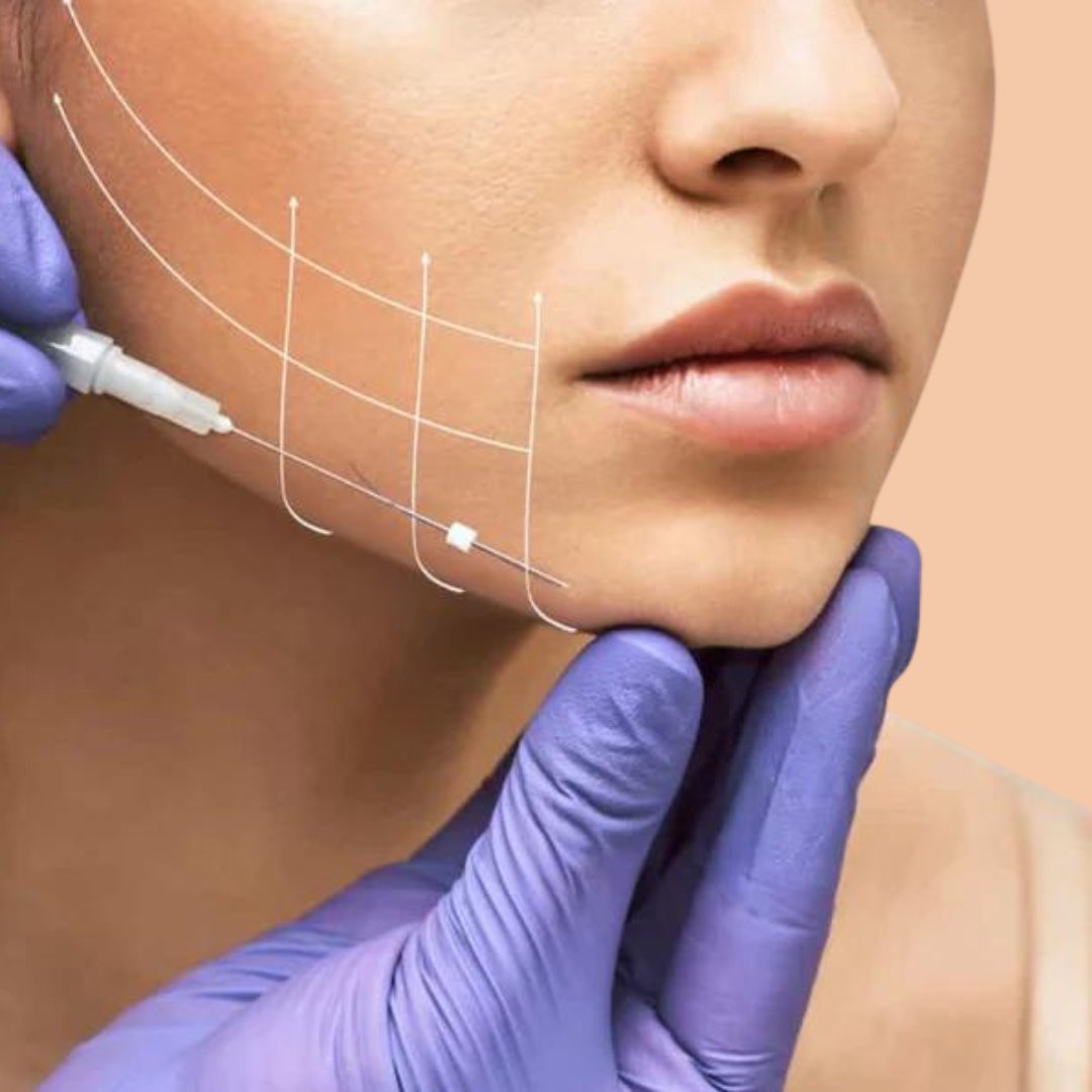 Thread Lifts (PDO and COGS)