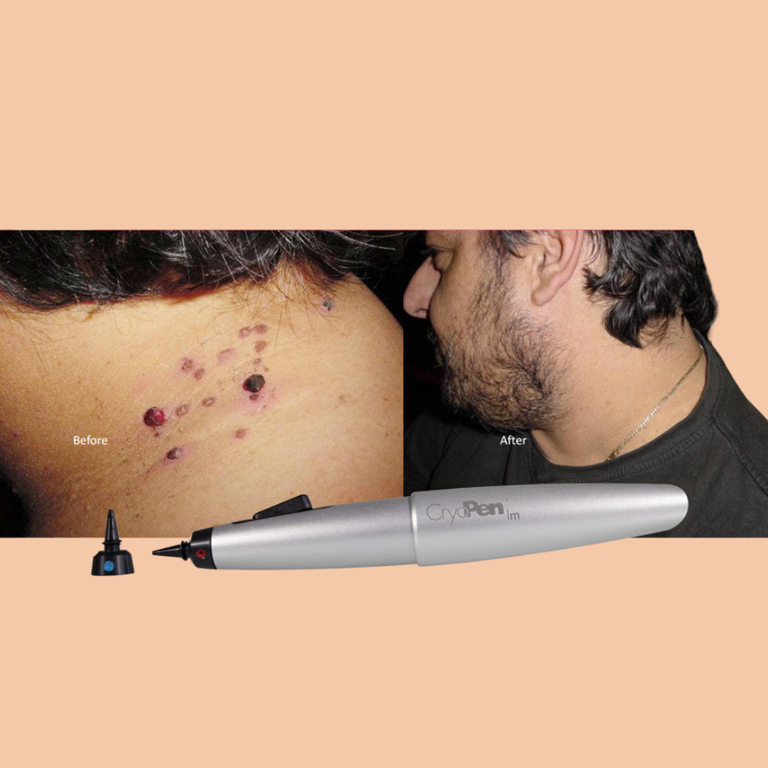 Cryopen Treatment - skin tag, mole, wart removal or Milia manual removal