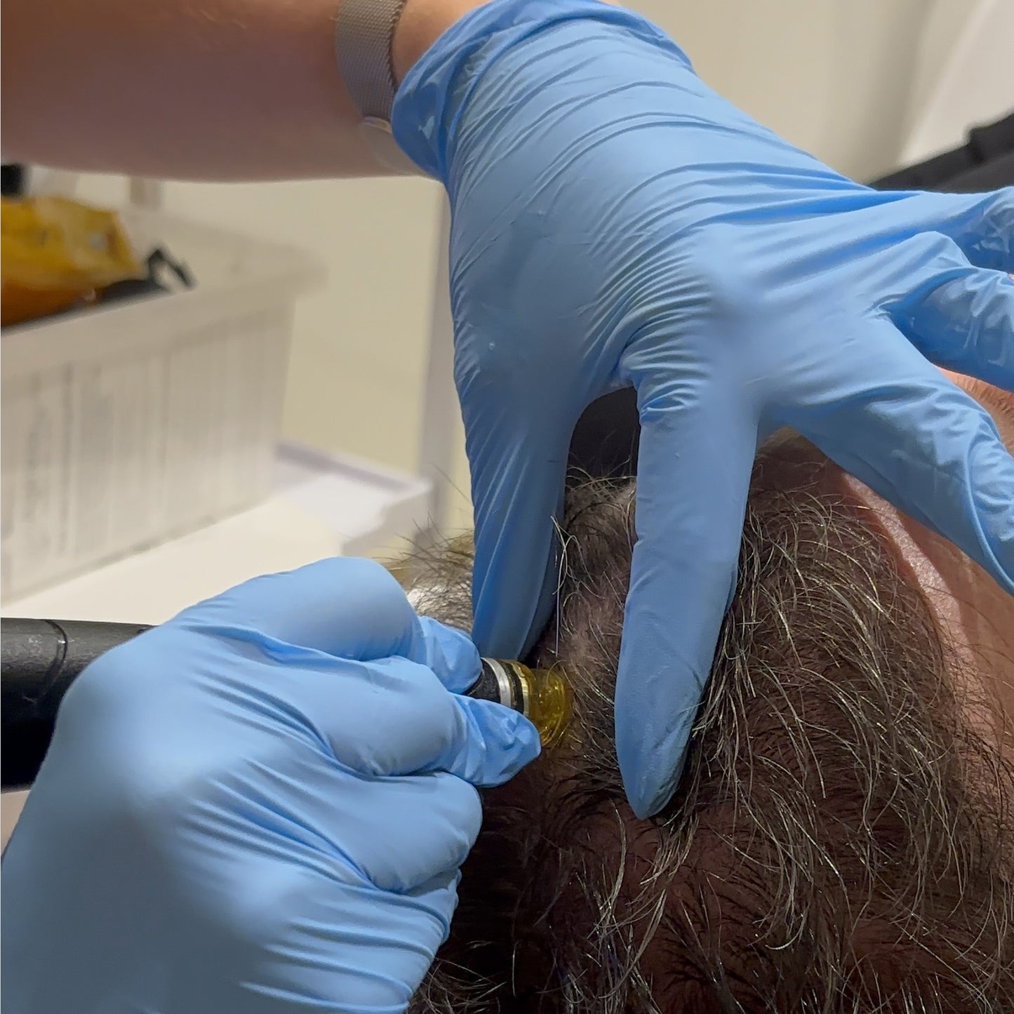 Person with blue gloves applying a substance to a person's head using a tool.