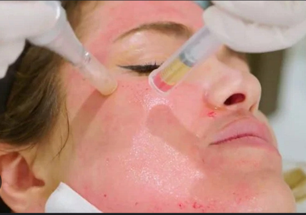 Vampire PRP Facial