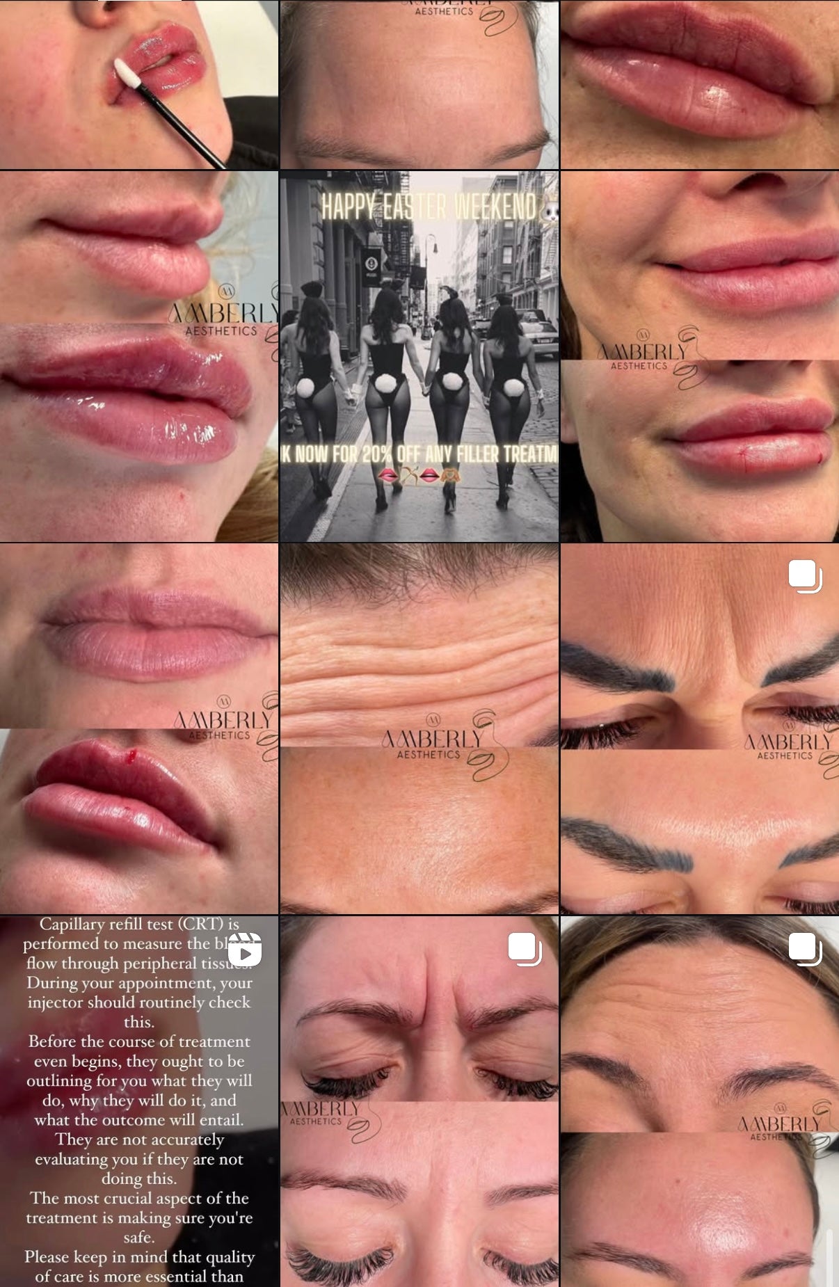 Dermal Filler - Lips 0.7ml