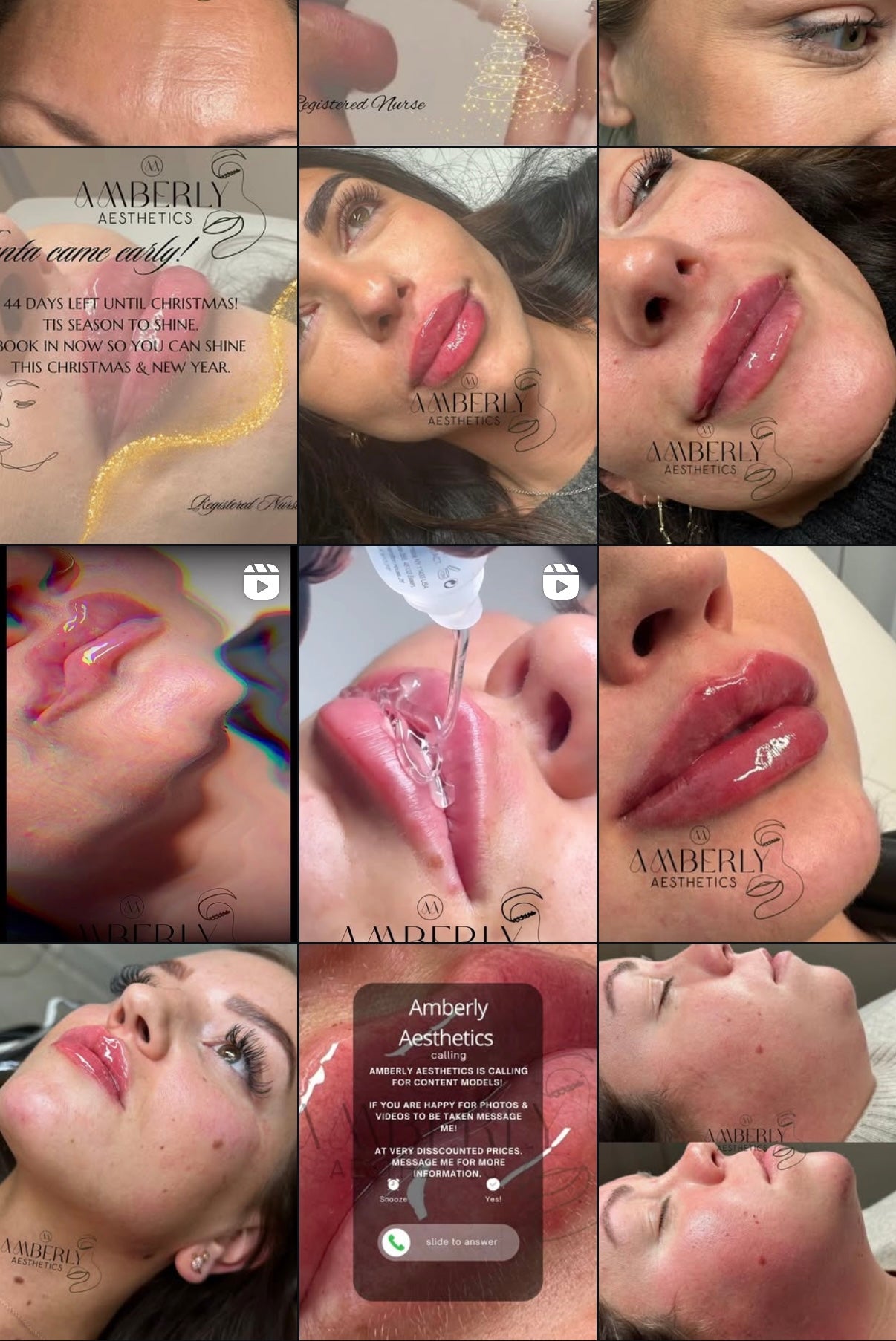 Dermal Filler - Lips 0.7ml