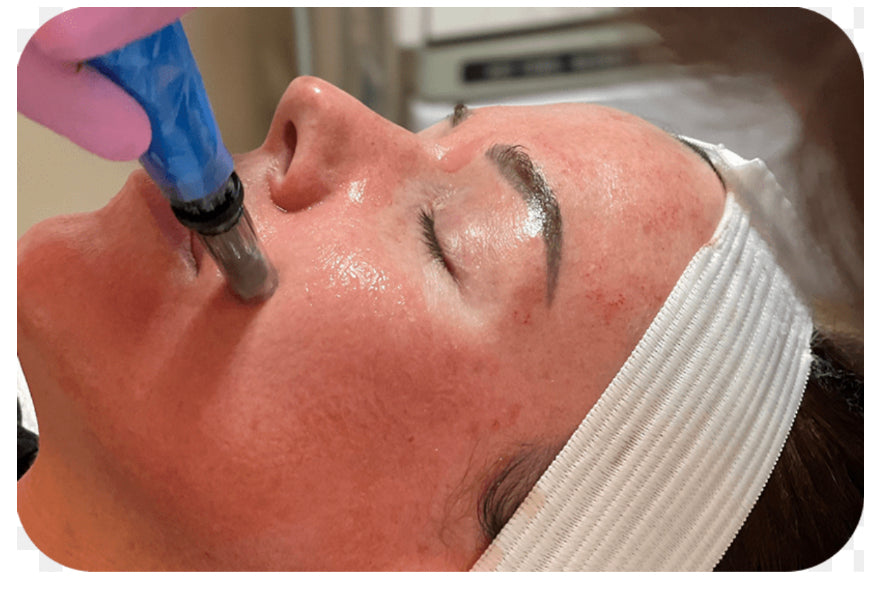 Dermapen - Microneedling