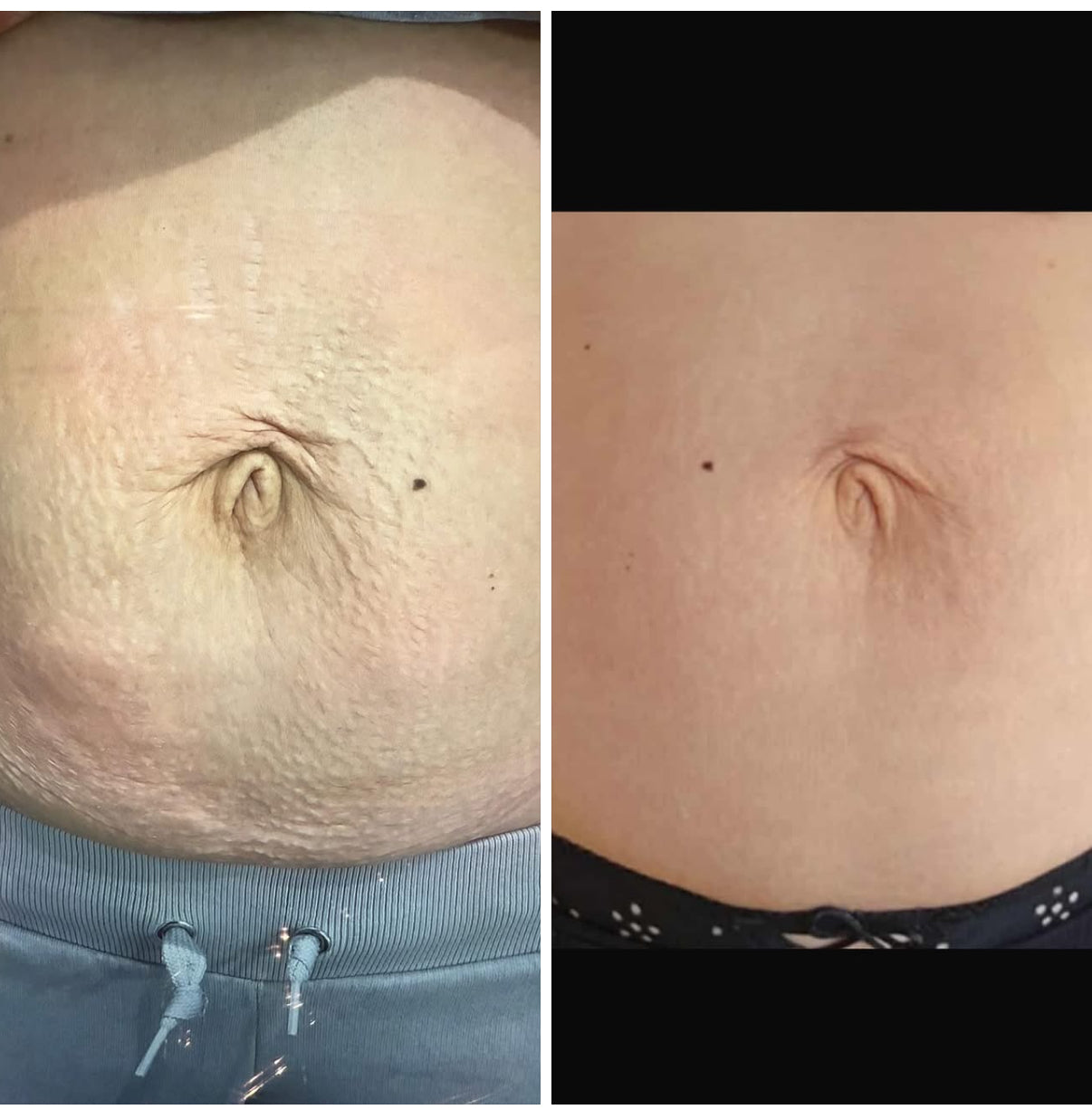 Dermapen - Medical Microneedling
