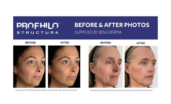 Profhilo® Structura (NEW PRODUCT) – Ageless By Nikki