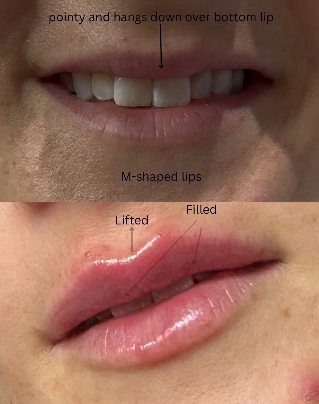 Dermal Fillers - Lips and fine lines 1ml