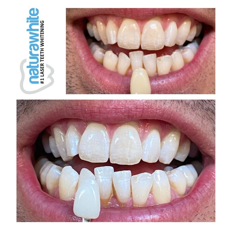 Teeth Whitening - 2 Sessions